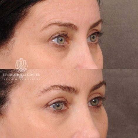 Beverly Hills Center Female Patient Before and After Upper Blepharoplasty with Fat Repositioning
