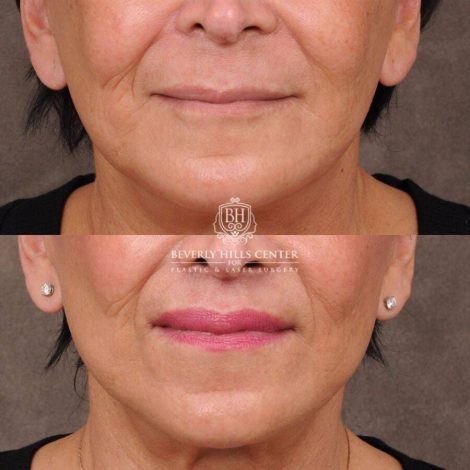 Beverly Hills Center Female Patient Before and After CUPID LIFT® Lip Lift