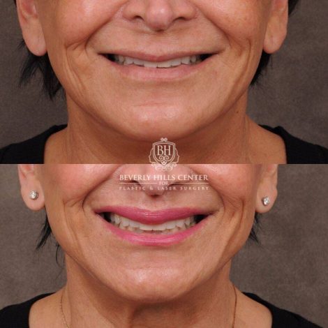 Beverly Hills Center Female Patient Before and After CUPID LIFT® Lip Lift