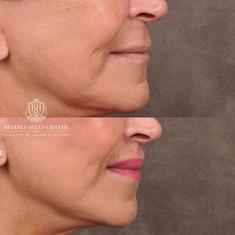Beverly Hills Center Female Patient Before and After CUPID LIFT® Lip Lift