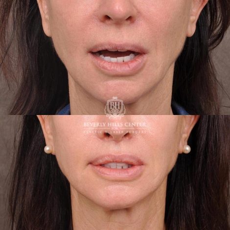 Beverly Hills Center Female Patient Before and After Lip Lift with Left Corner Procedure