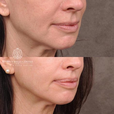 Beverly Hills Center Female Patient Before and After Lip Lift with Left Corner Procedure