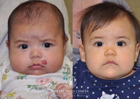 Beverly Hills Center Female Patient Before and After Hemangioma Treatment