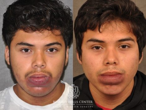 Beverly Hills Center Male Patient Before and After Port Wine Stain Removal