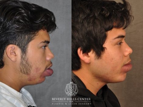 Beverly Hills Center Male Patient Before and After Port Wine Stain Removal