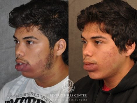 Beverly Hills Center Male Patient Before and After Port Wine Stain Removal
