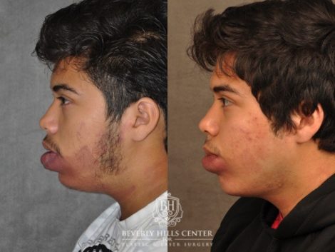 Beverly Hills Center Male Patient Before and After Port Wine Stain Removal
