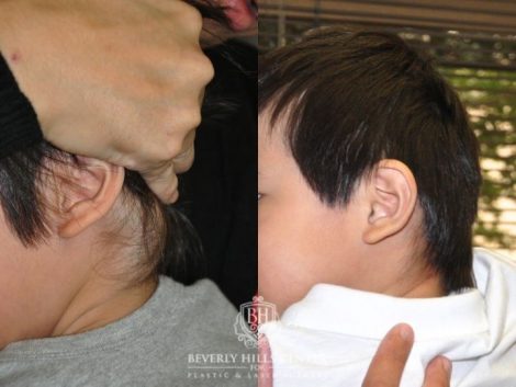 Beverly Hills Center Female Patient Before and After Lymphatic Malformation Treatment