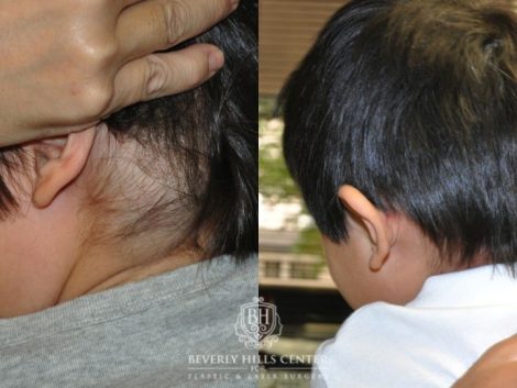 Beverly Hills Center Female Patient Before and After Lymphatic Malformation Treatment