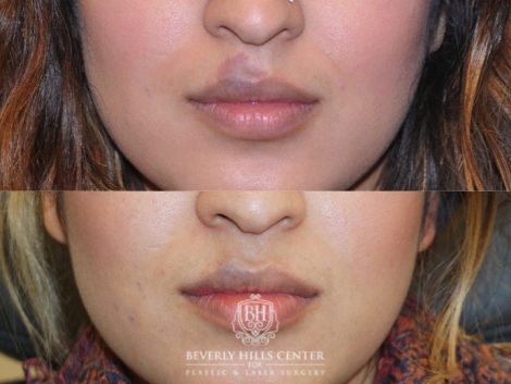 Beverly Hills Center Female Patient Before and After Port Wine Stain Removal