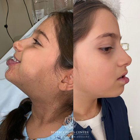 Beverly Hills Center Female Patient Before and After Hemangioma Treatments