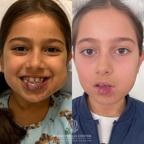 Beverly Hills Center Female Patient Before and After Hemangioma Treatments