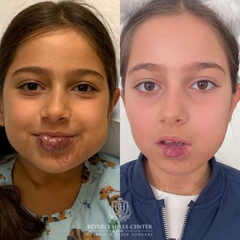 Beverly Hills Center Female Patient Before and After Hemangioma Treatments