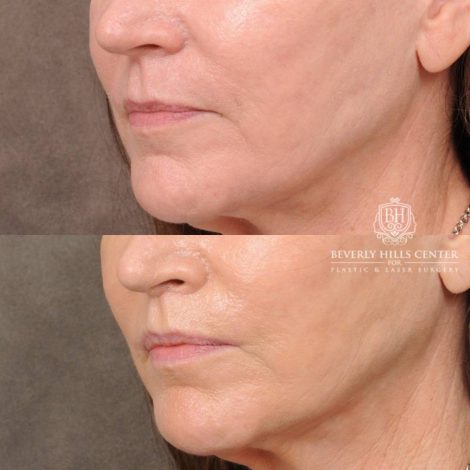 Beverly Hills Center Female Patient Before and After CUPID LIFT® Lip Lift