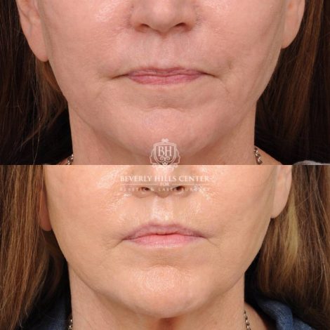 Beverly Hills Center Female Patient Before and After CUPID LIFT® Lip Lift