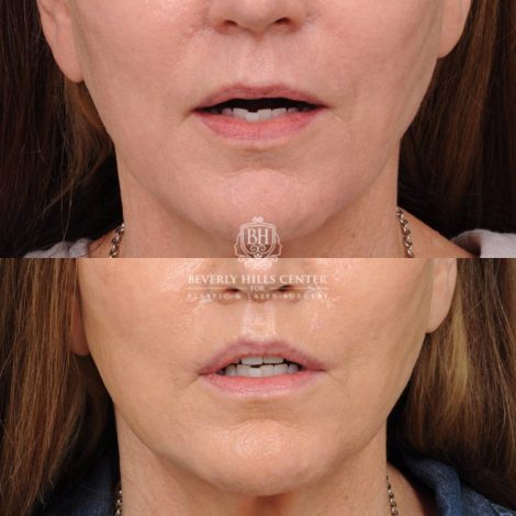 Beverly Hills Center Female Patient Before and After CUPID LIFT® Lip Lift
