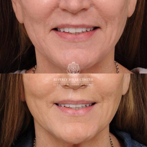 Beverly Hills Center Female Patient Before and After CUPID LIFT® Lip Lift