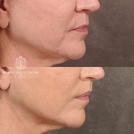 Beverly Hills Center Female Patient Before and After CUPID LIFT® Lip Lift