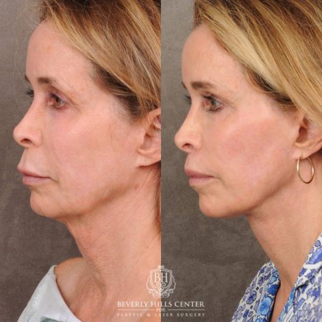 Beverly Hills Center Female Patient Before and After AuraLyft, Brow Lift, CUPID LIFT® Lip Lift, and Upper Blepharoplasty