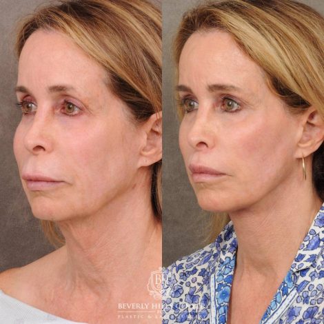 Beverly Hills Center Female Patient Before and After AuraLyft, Brow Lift, CUPID LIFT® Lip Lift, and Upper Blepharoplasty
