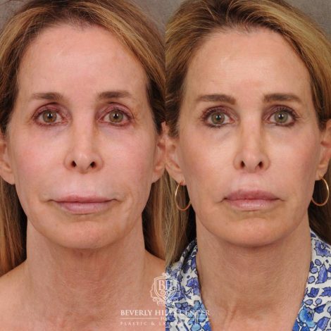 Beverly Hills Center Female Patient Before and After AuraLyft, Brow Lift, CUPID LIFT® Lip Lift, and Upper Blepharoplasty