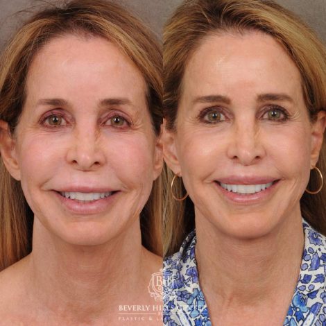 Beverly Hills Center Female Patient Before and After AuraLyft, Brow Lift, CUPID LIFT® Lip Lift, and Upper Blepharoplasty