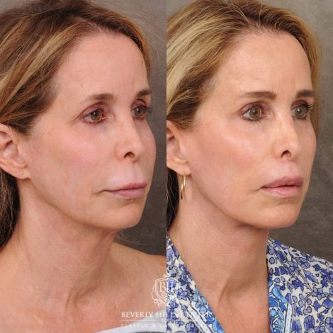 Beverly Hills Center Female Patient Before and After AuraLyft, Brow Lift, CUPID LIFT® Lip Lift, and Upper Blepharoplasty