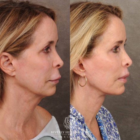 Beverly Hills Center Female Patient Before and After AuraLyft, Brow Lift, CUPID LIFT® Lip Lift, and Upper Blepharoplasty