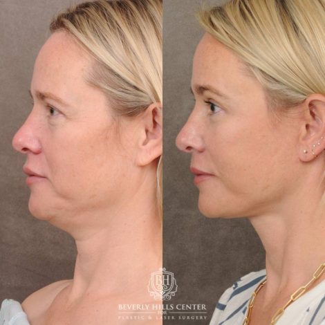 Beverly Hills Center Female Patient Before and After Auralyft, Brow Lift, Upper & Lower Blepharoplasty