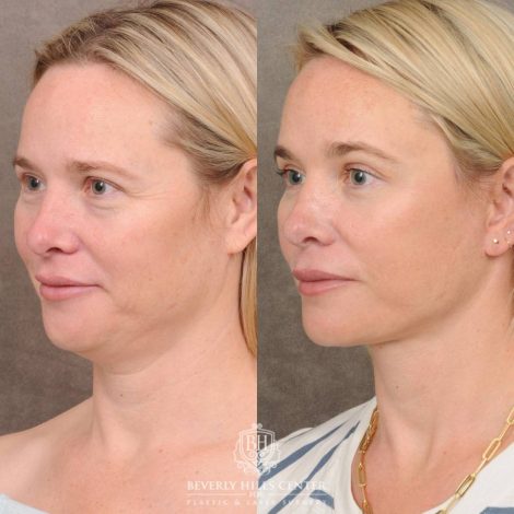 Beverly Hills Center Female Patient Before and After Auralyft, Brow Lift, Upper & Lower Blepharoplasty