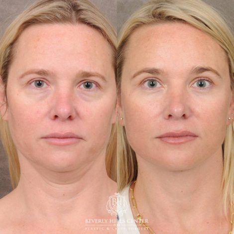 Beverly Hills Center Female Patient Before and After Auralyft, Brow Lift, Upper & Lower Blepharoplasty