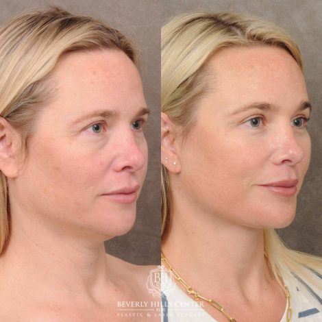 Beverly Hills Center Female Patient Before and After Auralyft, Brow Lift, Upper & Lower Blepharoplasty
