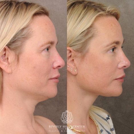 Beverly Hills Center Female Patient Before and After Auralyft, Brow Lift, Upper & Lower Blepharoplasty