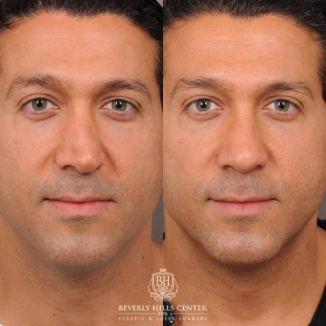 Beverly Hills Center Female Patient Before and After Rhinoplasty