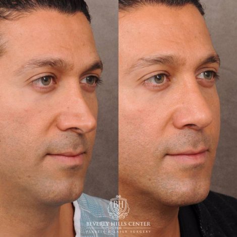 Beverly Hills Center Female Patient Before and After Rhinoplasty