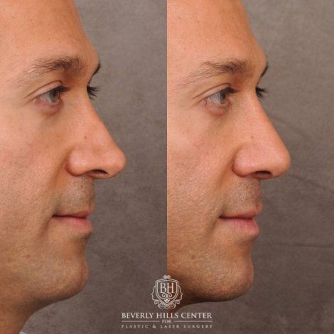 Beverly Hills Center Female Patient Before and After Rhinoplasty