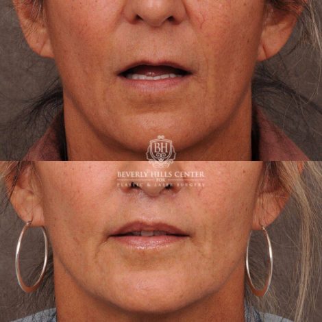 Beverly Hills Center Female Patient Before and After