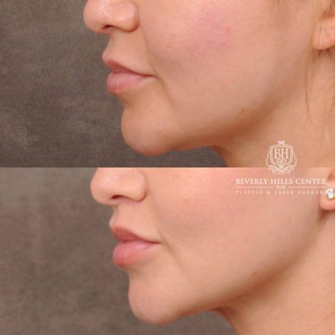 Beverly Hills Center Female Patient Before and After CUPID LIFT® Corner Lift