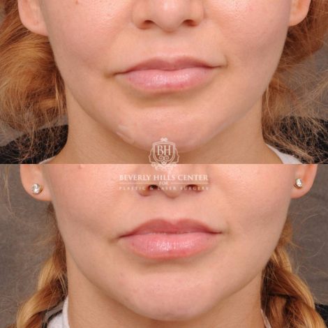 Beverly Hills Center Female Patient Before and After