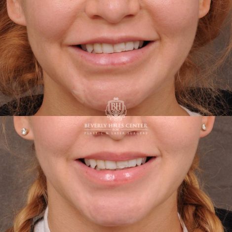 Beverly Hills Center Female Patient Before and After