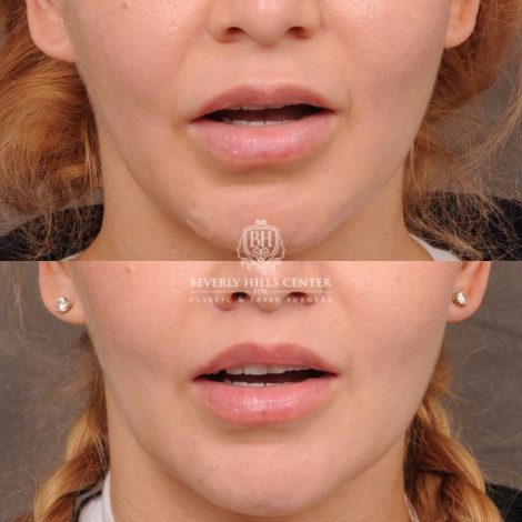 Beverly Hills Center Female Patient Before and After