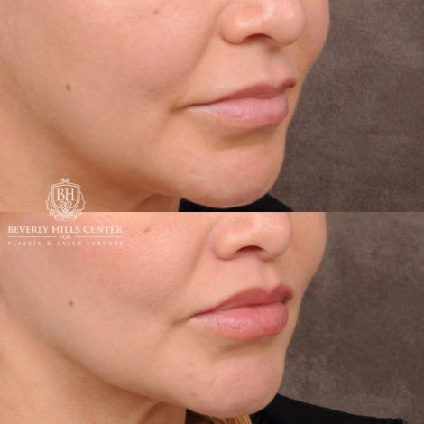 Beverly Hills Center Female Patient Before and After