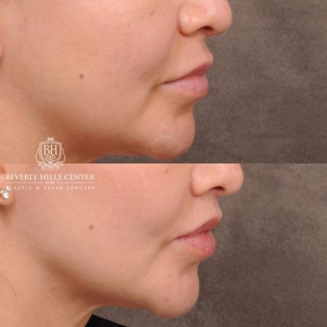 Beverly Hills Center Female Patient Before and After