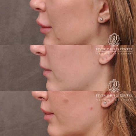 Beverly Hills Center Female Patient Before and After Lip Lift after Dissolver
