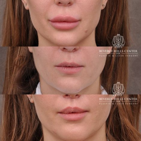 Beverly Hills Center Female Patient Before and After Lip Lift after Dissolver