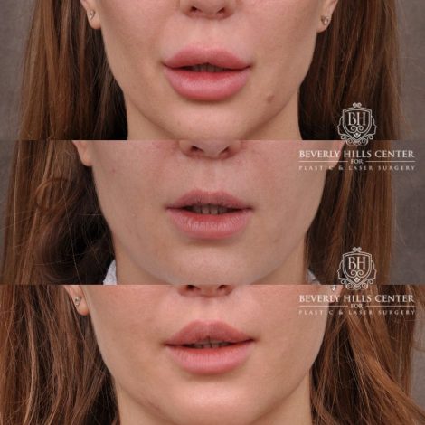 Beverly Hills Center Female Patient Before and After Lip Lift after Dissolver