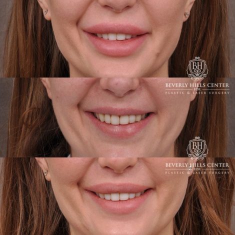 Beverly Hills Center Female Patient Before and After Lip Lift after Dissolver
