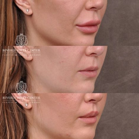 Beverly Hills Center Female Patient Before and After Lip Lift after Dissolver