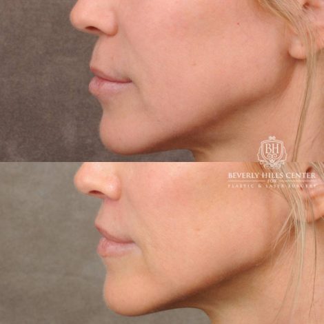 Beverly Hills Center Female Patient Before and After CUPID LIFT® Lip Lift, Profound RF
