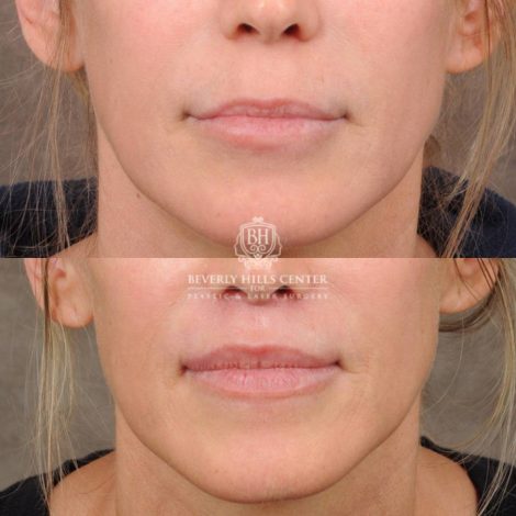Beverly Hills Center Female Patient Before and After CUPID LIFT® Lip Lift, Profound RF